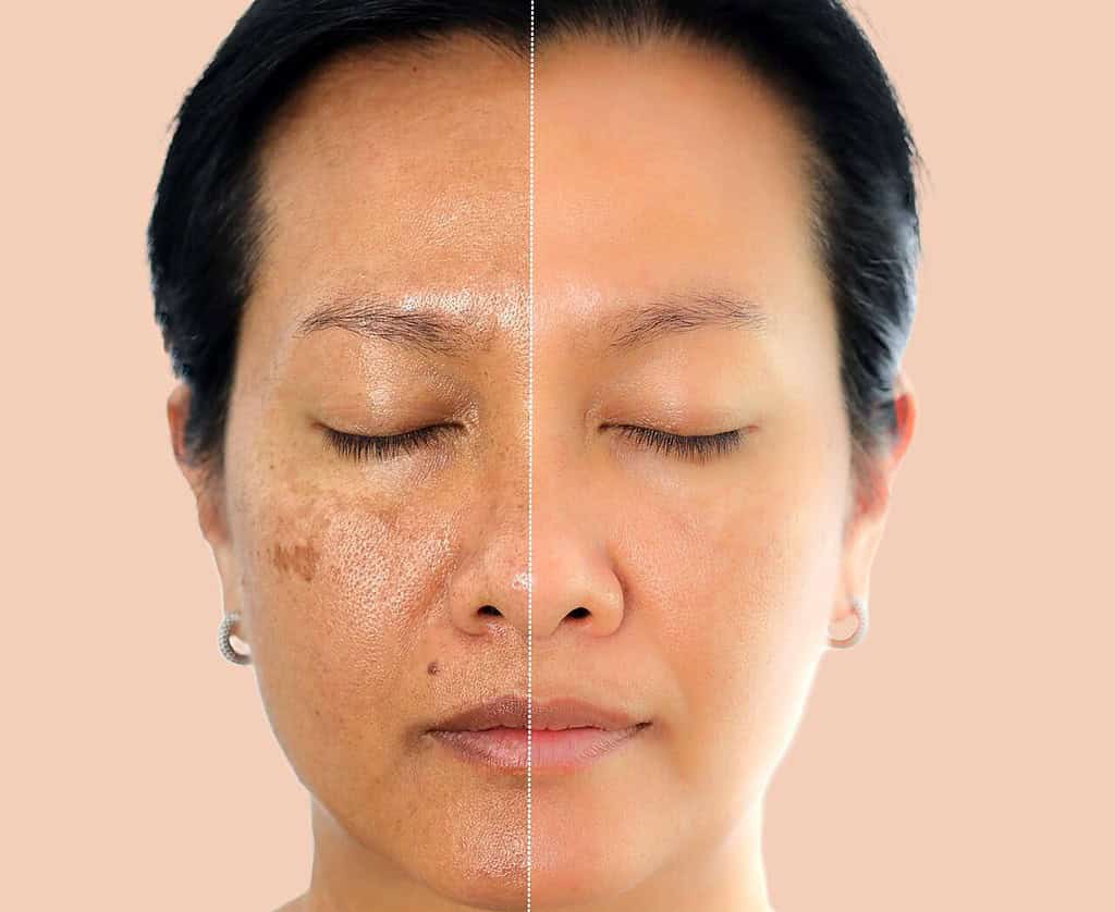 A woman shows the results of effective skin whiteners.