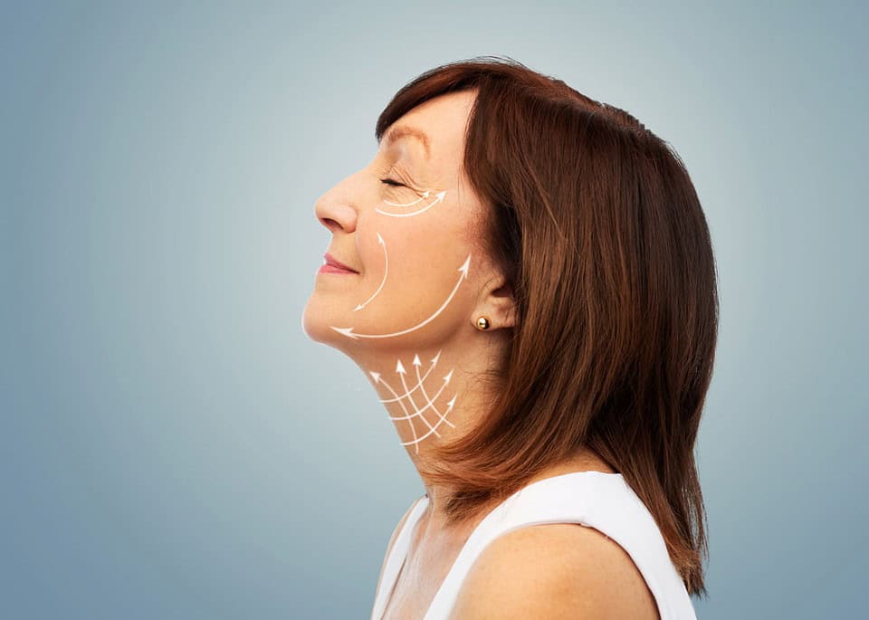Arrows marking a woman’s face to show facelift surgery directions