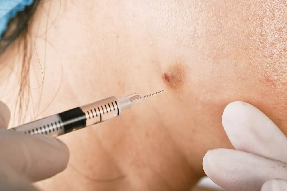 A woman getting cystic acne injection treatment