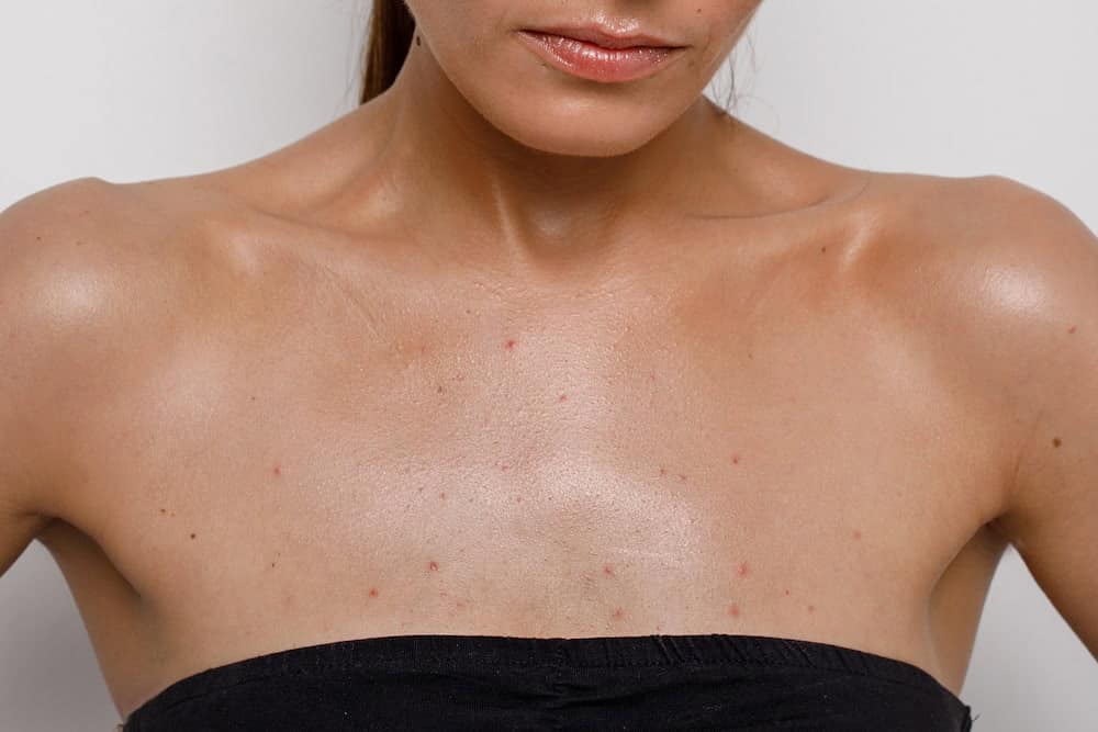 Hormonal acne can appear on the chest, shoulders and back