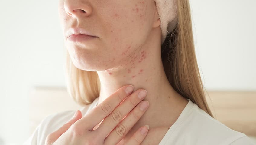 Woman-with-inflamed-cystic-acne-on-her-nec