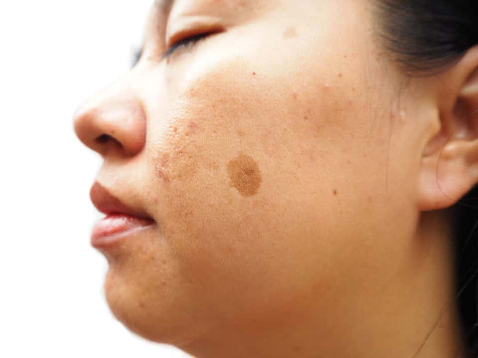 A case of melasma on a woman’s cheek.