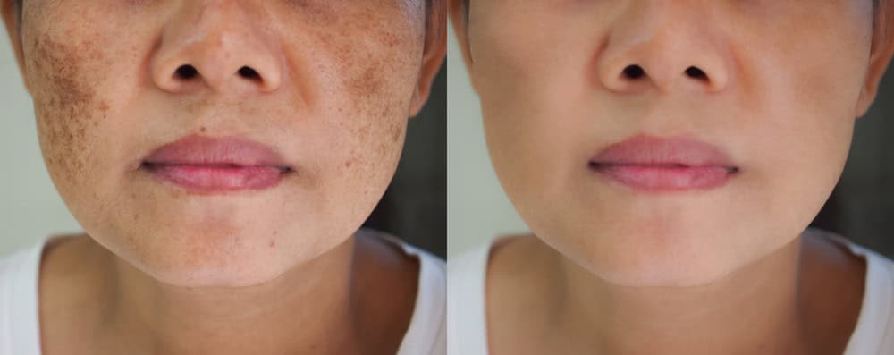 Before and after melasma treatment results in Bangkok