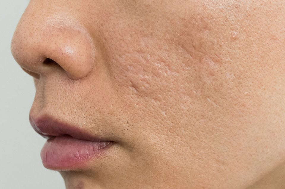 Acne scars on an Asian man's face