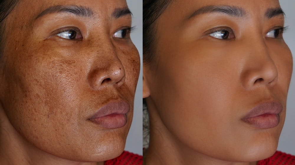 Before and after a laser skin whitening treatment