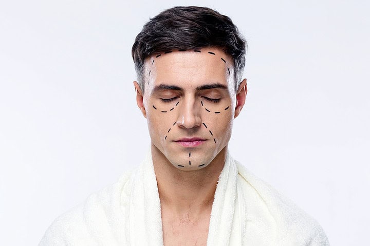 A man illustrates some areas of facial feminization.