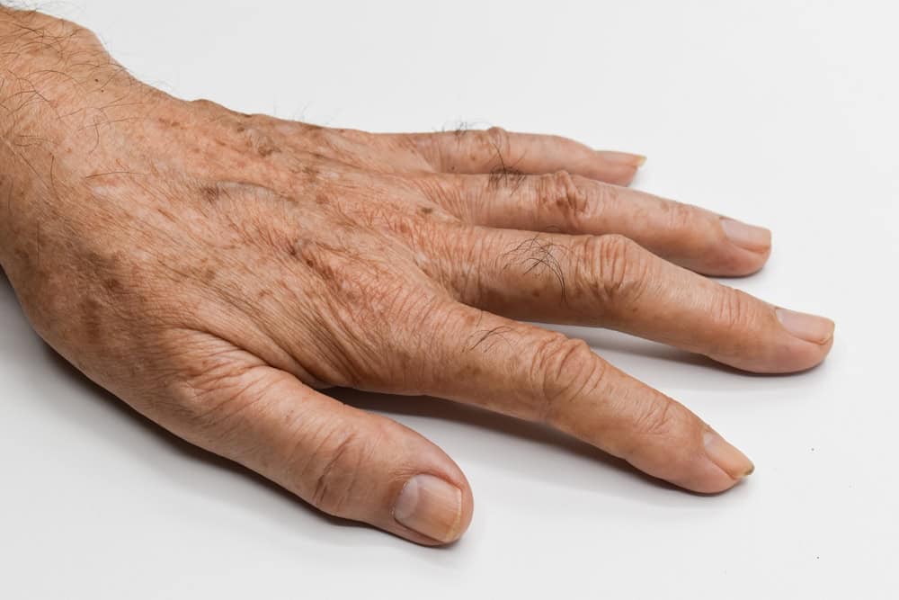 The backs of hands are common areas for dark spots.