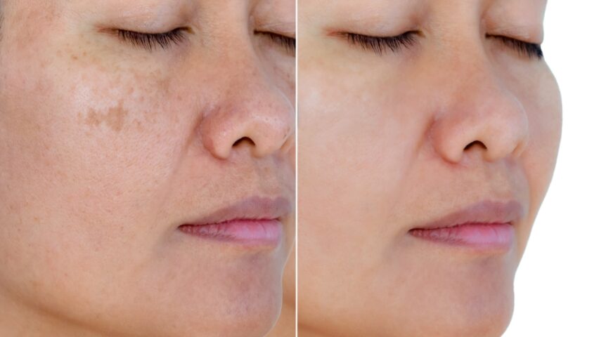 Before and after images of dark spot removal laser treatment.