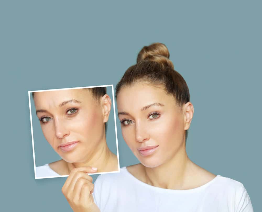  A woman’s before and after skin boosters and biostimulators in Bangkok