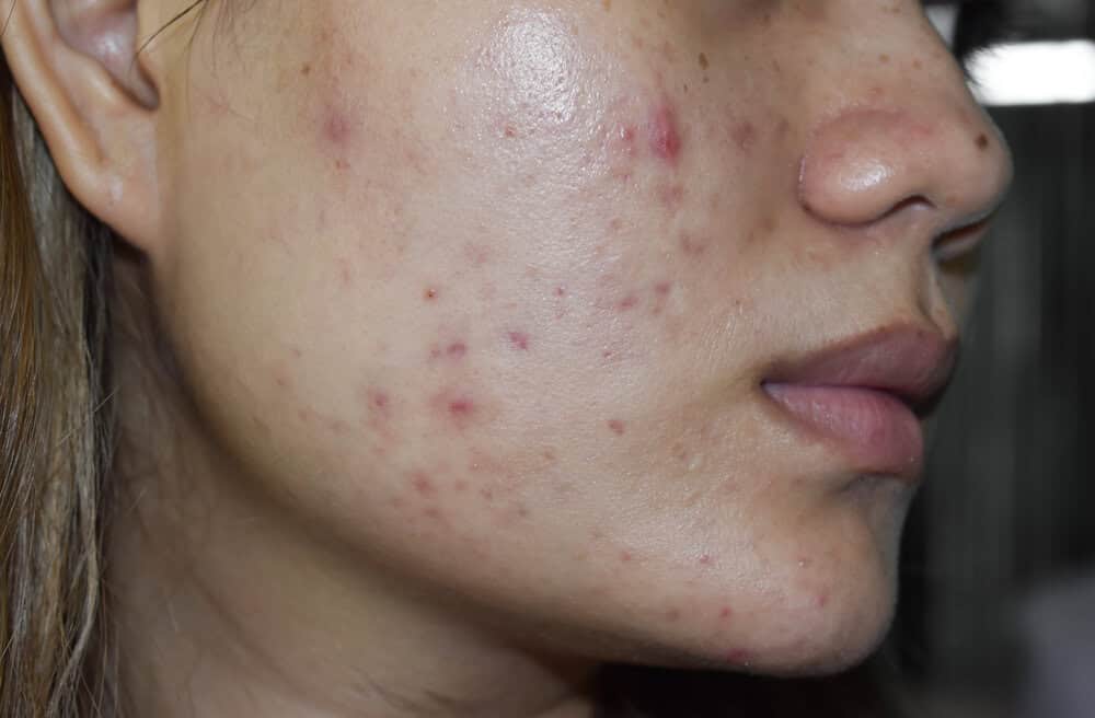 Severe acne that could benefit from treatment