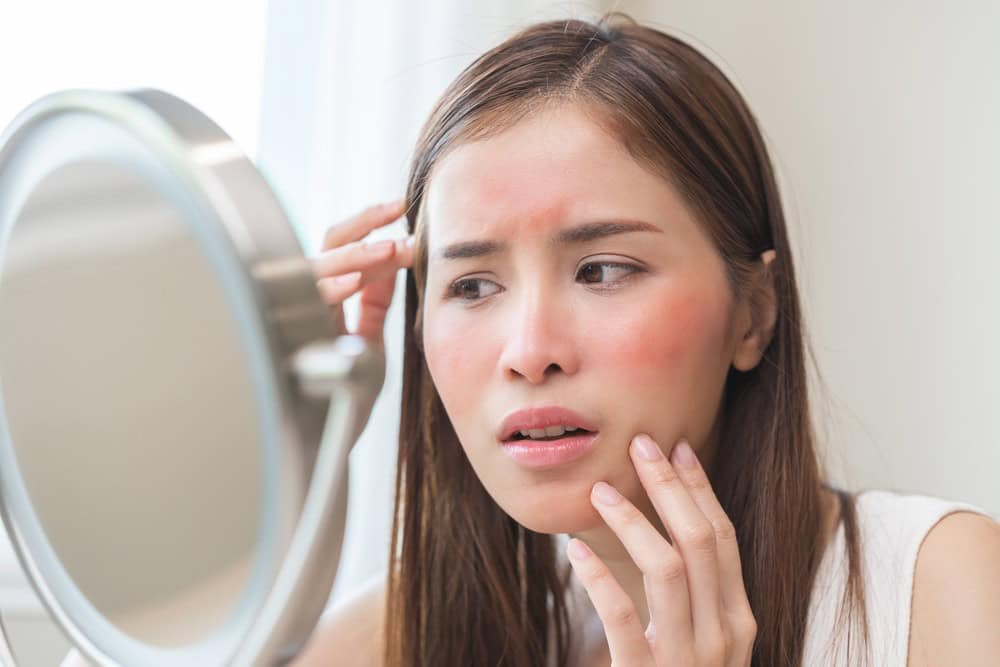 A woman has concerns about severe acne 