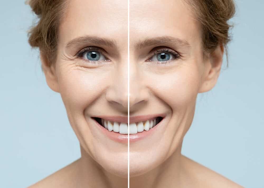  A woman’s face before and after anti-aging treatment