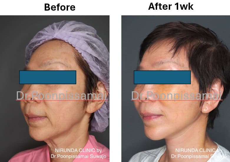 Facelift Review