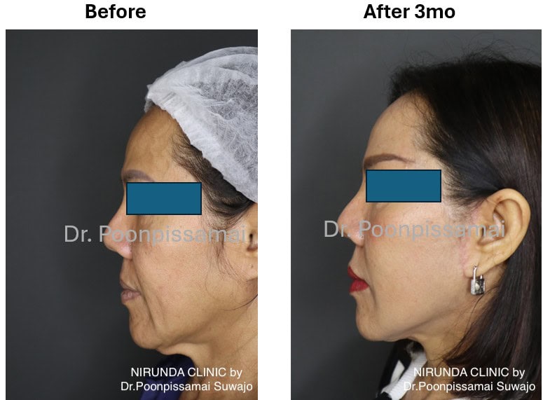 Facelift Review