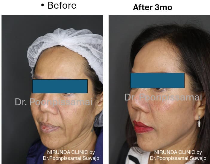 Facelift Review