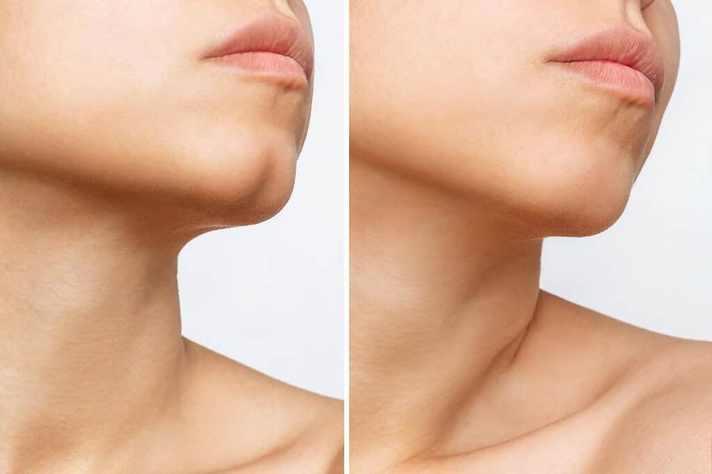 Chin filler makes a significant difference