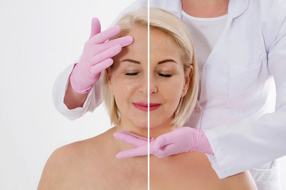 A woman’s before and after treatment for saggy cheeks