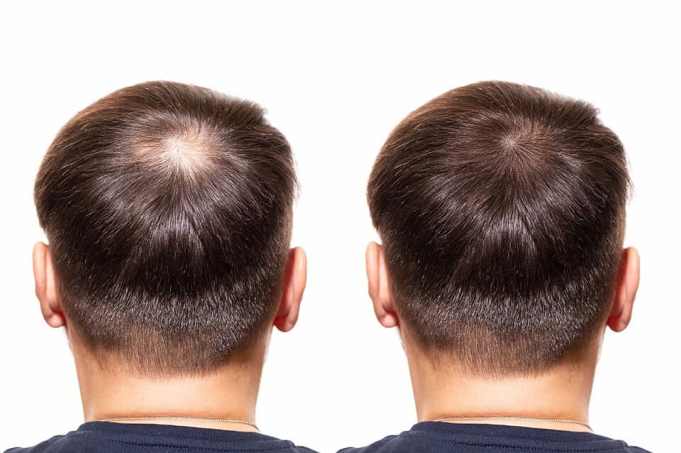 Before and after hair transplant in Bangkok