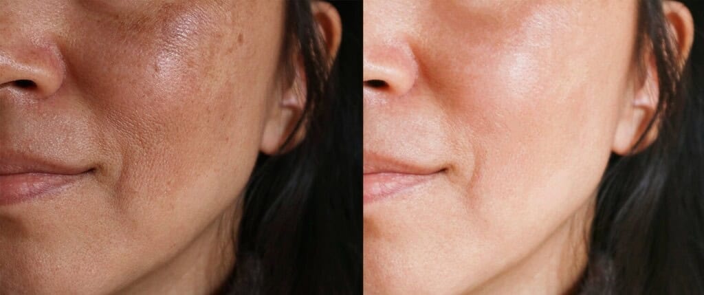 A woman’s before and after Ultherapy Prime treatment 