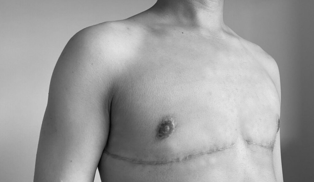 Patient after surgery for sex change female to male