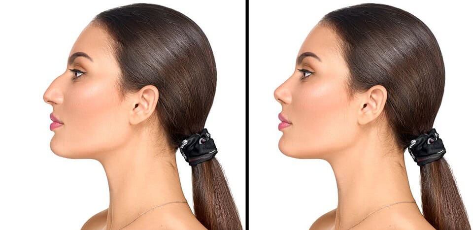 Rhinoplasty surgery gives you the type of nose you want