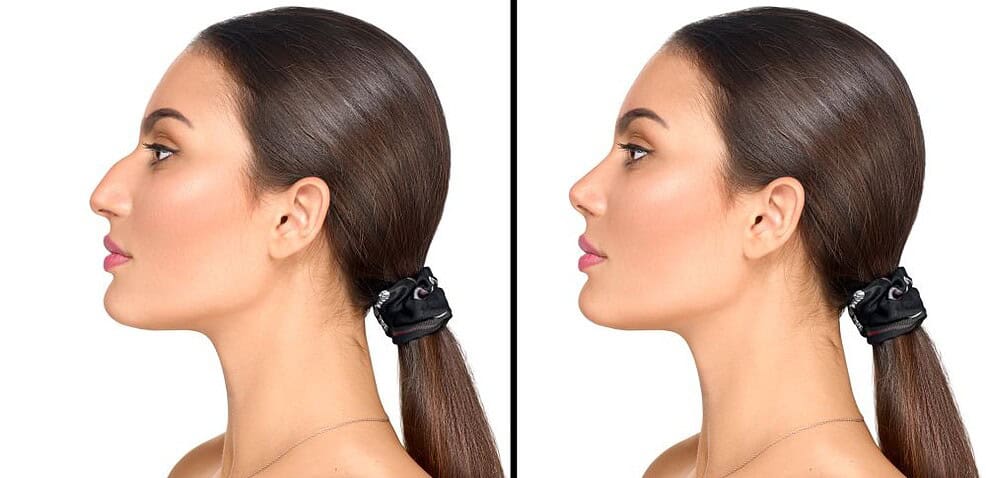 Rhinoplasty surgery gives you the type of nose you want