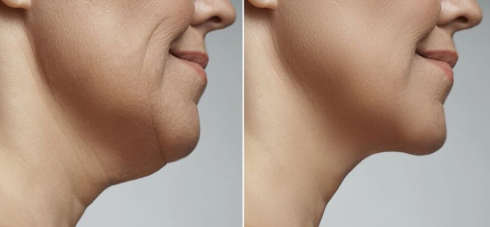 A turkey neck condition can be permanently fixed