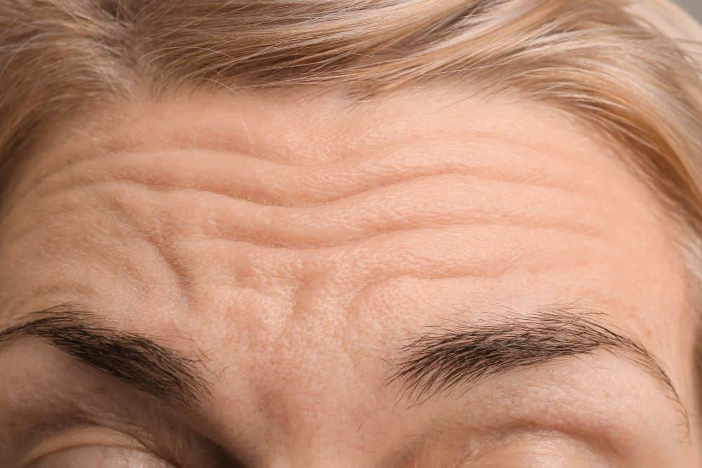 Reduce forehead wrinkles with Botox injections