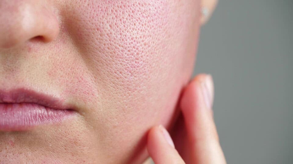 A photo of a woman’s skin with enlarged pores