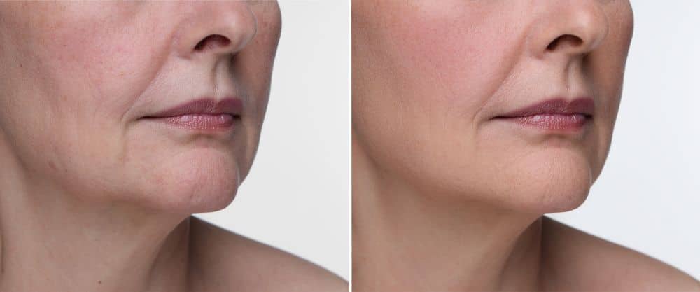 A woman’s HArmonyCa before and after journey