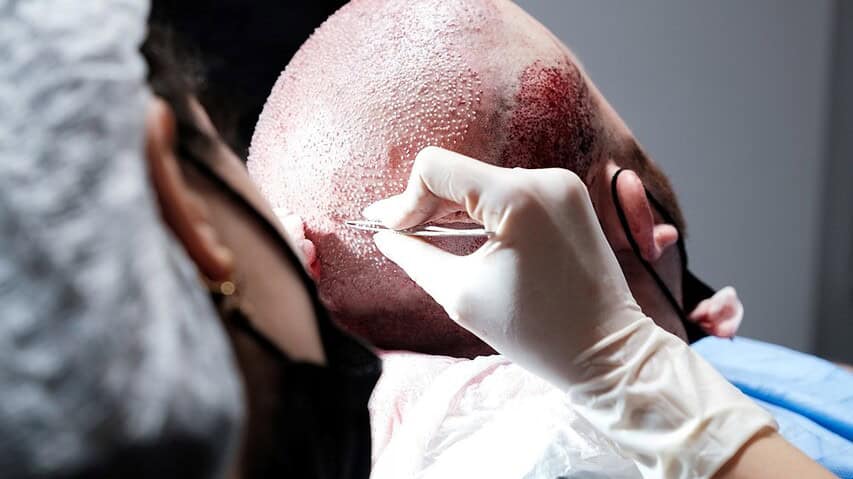 FUT hair transplant clinic in Bangkok Thailand