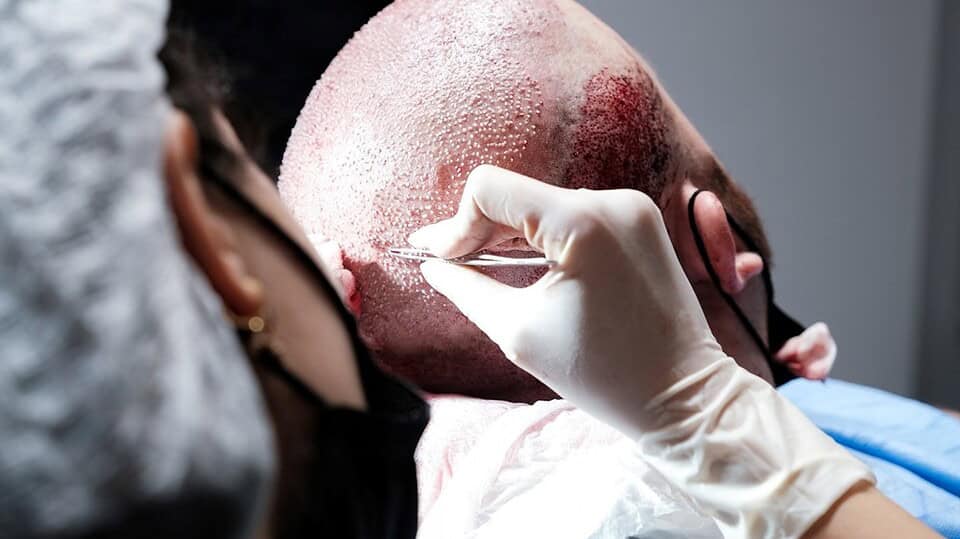 FUT hair transplant clinic in Bangkok Thailand
