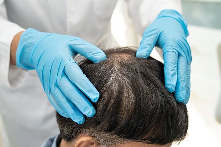 A doctor checking hair loss treatment options for a balding patient