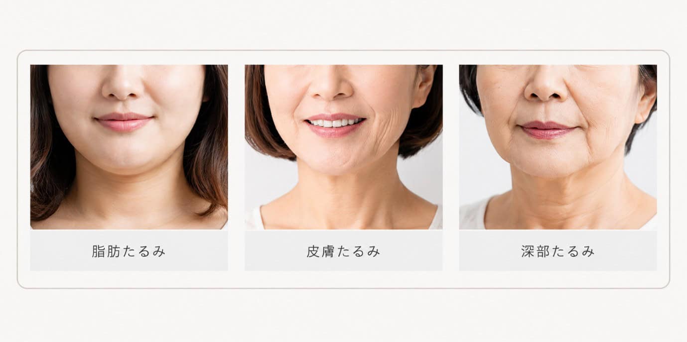 HIFU（ハイフ）とは？ RFとの違い・期待できる効果・向いている方