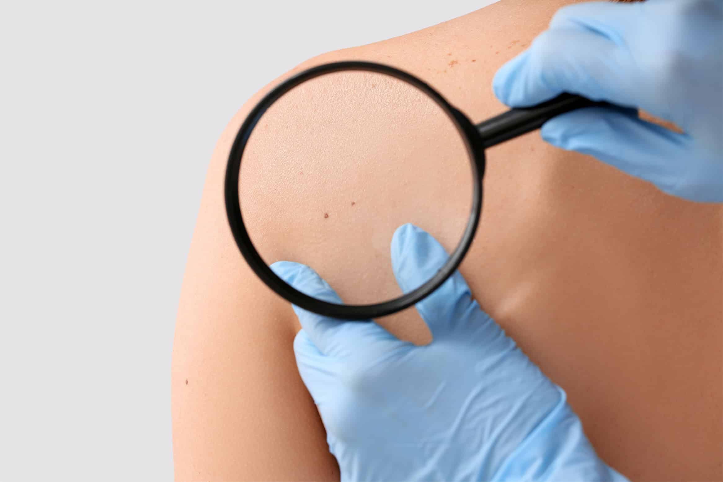 Dermatologist,Examining,Patient,On,Light,Background,,Closeup