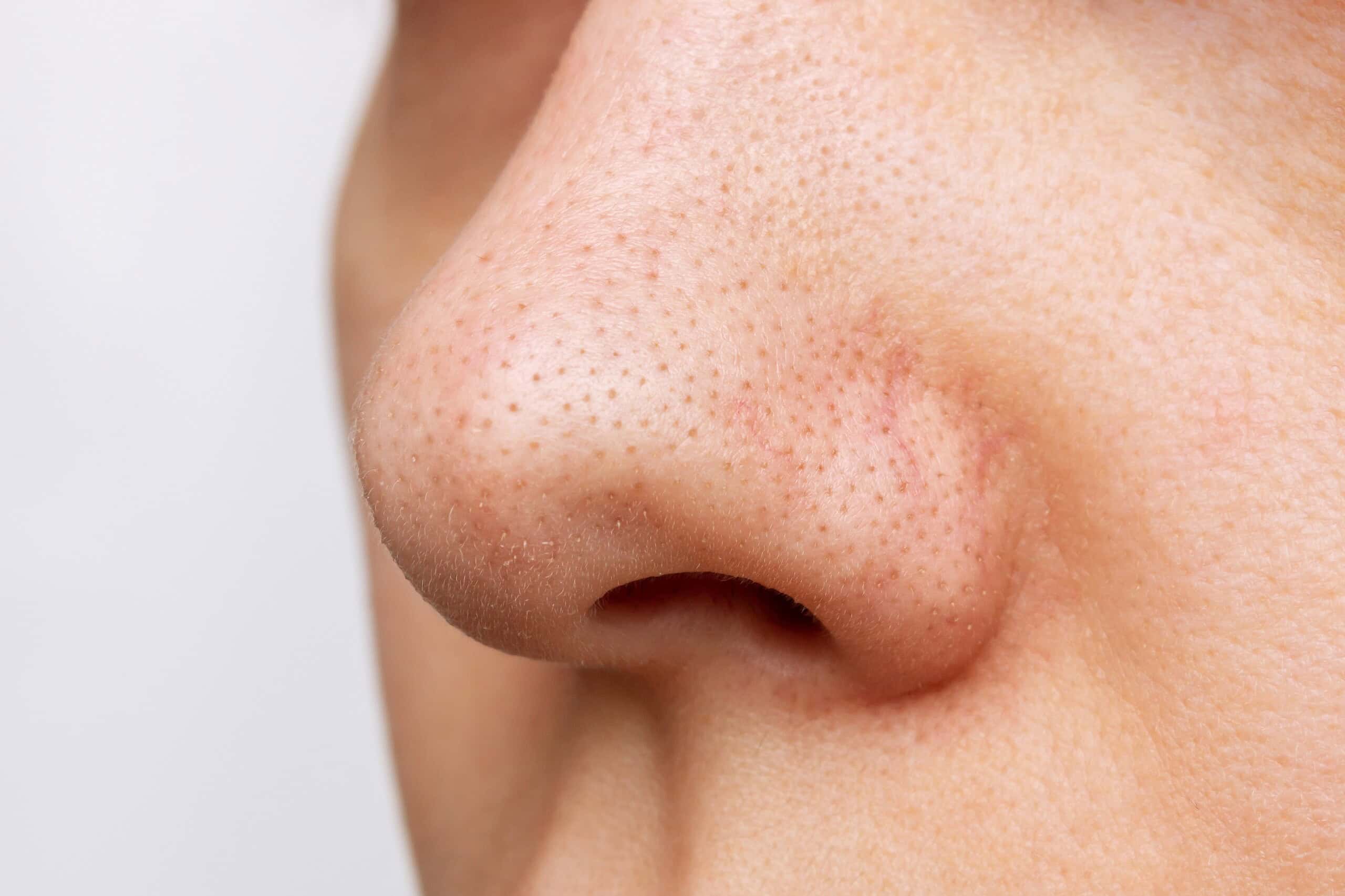 鼻の黒ずみが治らない原因とは？黒ずみの種類別に適した治療法を美容クリニックが解説