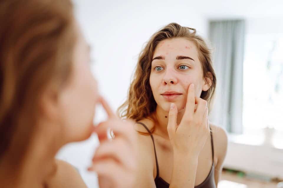 Young woman examining inflammatory acne on her forehead and cheeks in the mirror